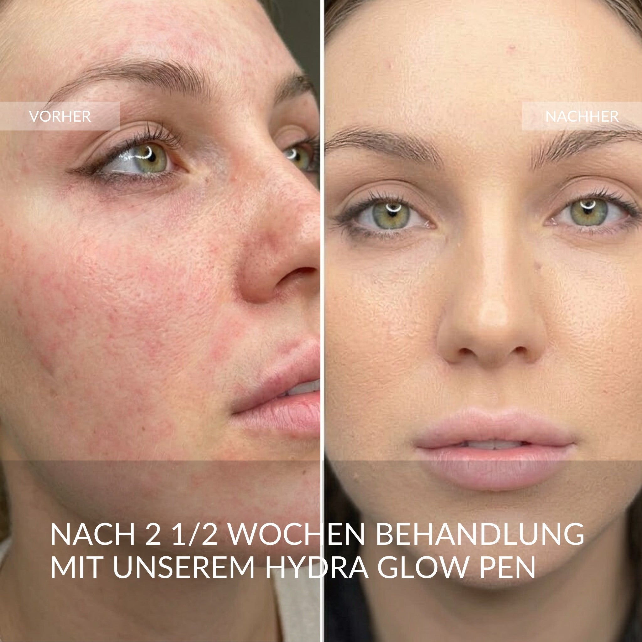 fleeky X Skinboom Sistema Hydra-Glow